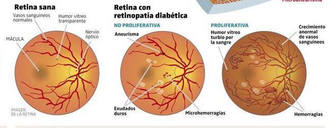 retinopatia-diabetica-atencion-en-guadalajara-mexico-copia-2