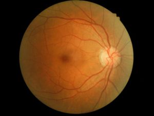 retina-normal2
