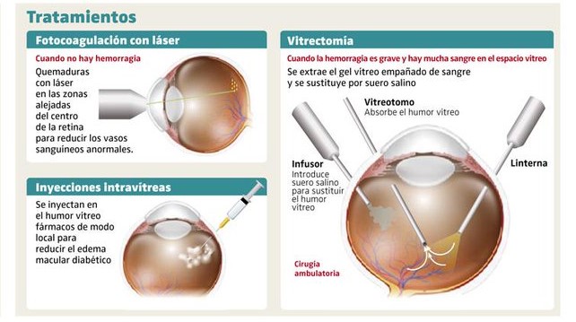 retinopatia-diabetica-atencion-en-guadalajara-mexico-copia-3